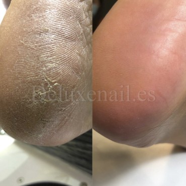 Queratolítico con urea para pedicura Podology+ NAILSOFTHEDAY, 100 ml