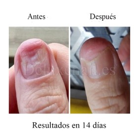 Onistop Podology+ NAILSOFTHEDAY, Tratamiento para prevenir y curar el hongo y la onicólisis de las uñas, 8 ml