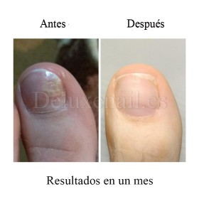 Onistop Podology+ NAILSOFTHEDAY, Tratamiento para prevenir y curar el hongo y la onicólisis de las uñas, 8 ml