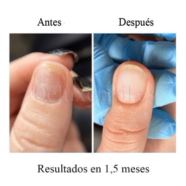 Onistop Podology+ NAILSOFTHEDAY, Tratamiento para prevenir y curar el hongo y la onicólisis de las uñas, 8 ml