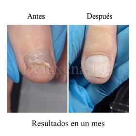 Onistop Podology+ NAILSOFTHEDAY, Tratamiento para prevenir y curar el hongo y la onicólisis de las uñas, 8 ml