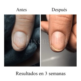 Onistop Podology+ NAILSOFTHEDAY, Tratamiento para prevenir y curar el hongo y la onicólisis de las uñas, 15 ml