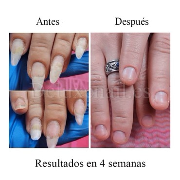 Onistop Podology+ NAILSOFTHEDAY, Tratamiento para prevenir y curar el hongo y la onicólisis de las uñas, 15 ml