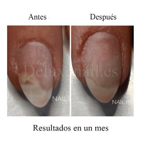 Onistop Podology+ NAILSOFTHEDAY, Tratamiento para prevenir y curar el hongo y la onicólisis de las uñas, 15 ml